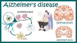 Understanding Alzheimers Disease Unraveling the Mystery and Seeking Hope 5 Minutes Microlearning [upl. by Shamma]