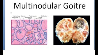 Pathology 810 a Goitre thyroid Multinodular adenomatous Plummer syndrome toxic [upl. by Haig392]