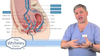 Pelvic Congestion Syndrome PCS explained [upl. by Lewis539]