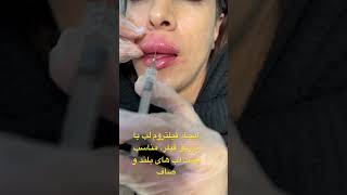 ‌create philtrum columnfiller injection Revaness [upl. by Annet688]