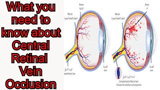 Central Retinal Vein Occlusion CRVO Blurred visionEye pain [upl. by Louls460]