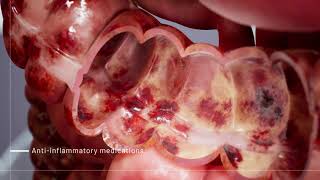 Ulcerative Colitis Medications  3D Medical Animation  Pixeldust Studios [upl. by Annadroj]