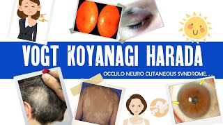 Vogt Koyanagi Harada syndrome  VKH  granulomatous uveitis  ophthalmology [upl. by Anitnelav]