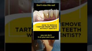 Removing Plaque From Teeth  How To Get Tartar off Teeth at Home tarta teeth dental [upl. by Tadashi]