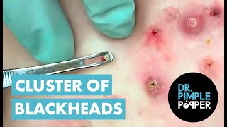 50 Minutes of Blackheads Clusters of Blackheads with Dr Pimple Popper [upl. by Gorden557]