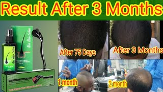 Neo Hair Lotion  Result After 3 Month hair treatment  shahidsialkoti [upl. by Tereb905]