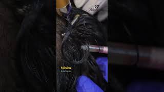 PRP Treatment for hair loss  Benefits of PRP  trending shorts reel skinclinic prp [upl. by Bertasi]