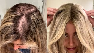 How Trichotillomania Change Your Life  Hair Topper Instant Hair Loss Solution [upl. by Remas]