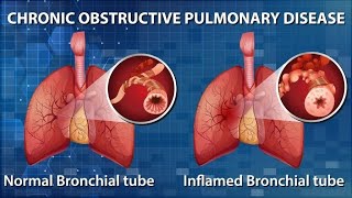 Breathe Easy in Understanding COPD 4 Minutes [upl. by Buine289]