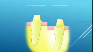 Crown Lenghtening VS Extrusion [upl. by Hansel]