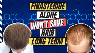 Reasons Finasteride Is Not Working  11 Year Experience Of Blocking DHT [upl. by Florida]