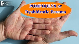 DYSHIDROTIC ECZEMA OR POMPHOLYX CausesSymptoms amp Treatment  Dr Aruna Prasad  Doctors Circle [upl. by Yrelav]