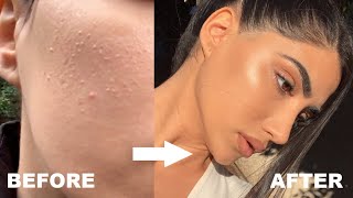 HOW I GOT RID OF STUBBORN BUMPS AND TEXTURED SKIN [upl. by Jeni231]