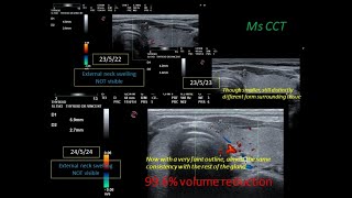 Percutaneous Ethanol Injection PEI 3 – Good Outcome [upl. by Valentino]