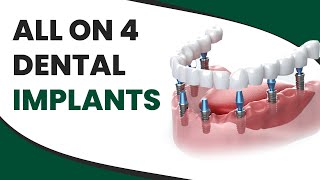 All on 4 Dental Implants [upl. by Goda732]