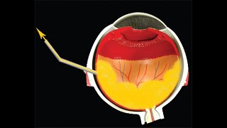 Novel Technique of External Subretinal Fluid Drainage SRFD for Exudative RD 2ry to Coats Disease [upl. by Anelim]