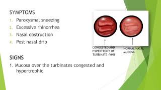 Vasomotor Rhinitis [upl. by Christabelle570]