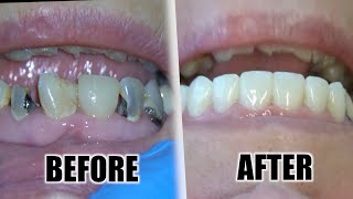 LIVE Tooth Cavity Removal Treatment for EXTENSIVE Tooth Decay [upl. by Nylrak]