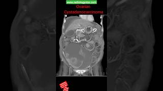 Ovarian Cystadenocarcinoma shorts radiology youtubeshorts [upl. by Eicyak]