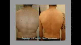 Male back clearance by electrolysis [upl. by Fihsak]