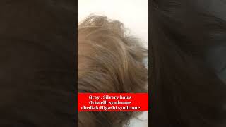 Griscelli syndrome  Chediak higashi syndrome HLH  Grey silvery in hairs kidsTests and treatment [upl. by Flyn]