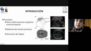 Journal Club en Terapia en Hernia Diafragmática Congénita [upl. by Einolem]