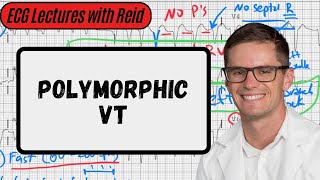 Polymorphic Ventricular Tachycardia  Day 23 ECG Challenge [upl. by Fanchan]