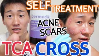 TCA CROSS 100 AT HOME SELF TREATMENT ON ACNE SCARS [upl. by Arret416]