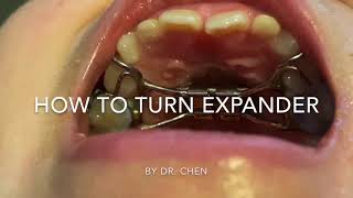 How to Turn Your Orthodontic Expander Appliance [upl. by Sharai]