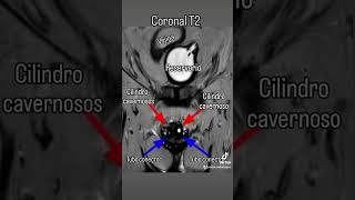 Prótesis Hidráulica de Pene shorts radiologia [upl. by Carce132]