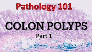 Colon Polyps  Part 1 Pathology 101 [upl. by Lennox963]