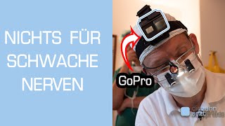 Zahnarzt filmt Weisheitszahn OP mit GoPro Vollnarkose [upl. by Eiznil299]