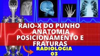 RAIO X DO PUNHO  ANATOMIA POSICIONAMENTO E FRATURAS  RADIOLOGIA DO PUNHO [upl. by Joshua426]