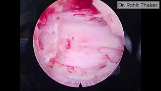 Interlaminar Endoscopic Decompression Lumbar Canal Stenosis L45 Dr Rohit Thaker spine doctor [upl. by Erbe]