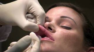 Dental Block Lip Numbing for Lip Augmentation by Northern Virginia Cosmetic Surgeon [upl. by Ranna]