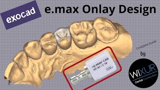 exocad emax Onlay Design [upl. by Rramaj152]