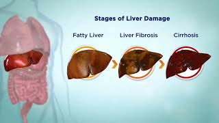 Hepatitis C HCV  Causes symptoms Diagnosis amp Treatment options [upl. by Guillema]