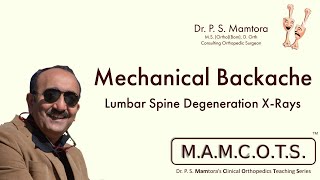 Mechanical Backache 23  Lumbar Spine Degeneration XRays  MAMCOTS [upl. by Avad]