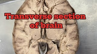 transverse section of brain  corpus callosum  lentiform nucleus Nepaliviral foryou [upl. by Norym]