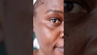 Syringoma removal at Derma skin clinic skincare skincareroutine mydermatfordarkspots [upl. by Ynor874]