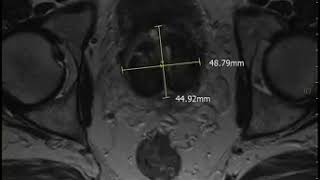 Prostate Artery Embolization results  Prostate Shrinkage [upl. by Htiderem]