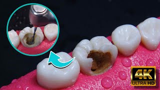 INCREIBLE reconstrucción de diente dañado por caries Endodoncia en 4K [upl. by Sainana]