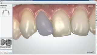 Dental System 2013  TRIOS Color Digital Temporary  3Shape [upl. by Yevi185]