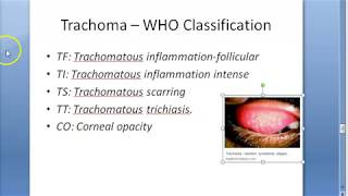 Ophthalmology 076 d Trachoma WHO Classification FISTO [upl. by Ecinnej]