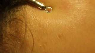 Blackhead extraction with Slow Motion HD  forehead zit [upl. by Innis]