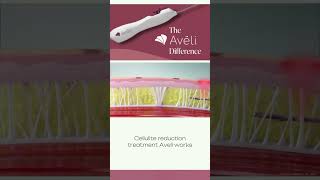 Curious about cellulite solutions Aveli got you 🌟 AveliTreatment CelluliteSolutions [upl. by Dweck692]