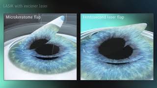 LASIK Treatment Animation Splitscreen [upl. by Hendel]