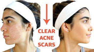 CLEAR ACNE SCARS FAST  DIY Face Masks That WORK [upl. by Mccourt]