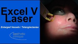 Excel V Laser treating Enlarged VesselsTelangiectasias [upl. by Namas]