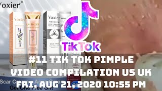 11 TIK TOK PIMPLE VIDEO COMPILATION US UK  21st August 2020 [upl. by Tana]